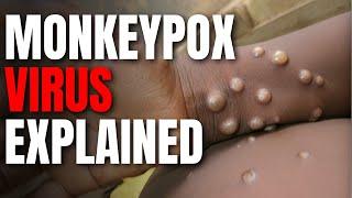 Is World Ready for Another Pandemic? MONKEYPOX Virus Explained