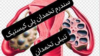 پنج درمان موثر تنبلی تخمدان یا سندرم تخمدان پلی کیستیک(PCOS) و مشکلات بارداری برای زنان