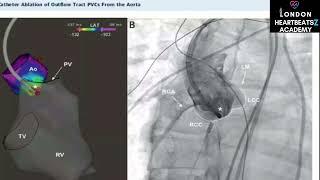 VT Catheter Ablation with & without structural heart disease activation/pace/substrate mapping MRI