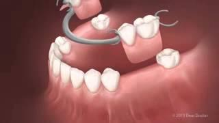 Smile Clinic Protezy ruchome Removable Dentures