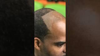 BARBERS STOP PUSHING HAIRLINES BACK ‍️