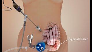 Colon cancer sigmoid colectomy - 3D animation surgical procedure