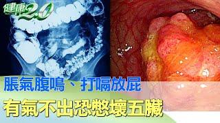 脹氣腹鳴、打嗝放屁 有氣不出恐憋壞五臟 健康2.0