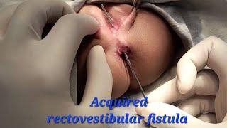 Acquired rectovestibular fistula resection in a female child / How do I do it