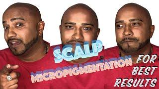 Best Scalp Micropigmentation Results - Ink 2 Scalp Micropigmentation Studios | Ontario