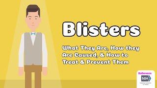 Blisters - What They Are, How they Are Caused, & How to Treat & Prevent Them