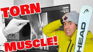 Torn Muscle!  Detached Biceps Tendon: Diagnosis and Treatment