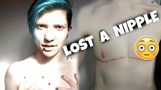 2 MONTHS POST OP || Non-Binary Top Surgery