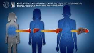 Domino Liver Transplantation for Leucinosis