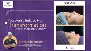 Rhinoplasty Surgery by Dr. Nitesh Lamoria | Nose Reshaping Expert | Nose surgery specialist