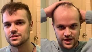 BALDING Twin Brothers Shave Their Heads BALD For The First Time