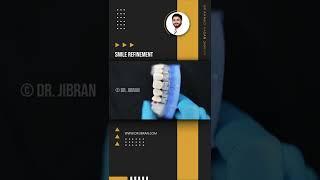 Smile Refinement | Dr. Jibran