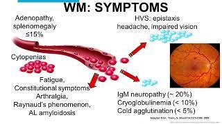 Experienced- Living Longer with WM with Dr. Prashant Kapoor