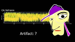 aEEG interpretation