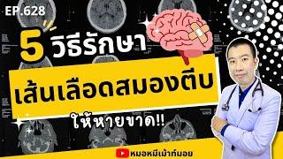 5 วิธีรักษาเส้นเลือดในสมองตีบให้หายขาด | เม้าท์กับหมอหมี EP.628