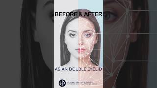 ASIAN DOUBLE EYELID SURGERY BEFORE & AFTER