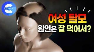 여자도 탈모에서 예외일 수 없다!! | 명의가 알려주는 여성 탈모 | 원형 탈모