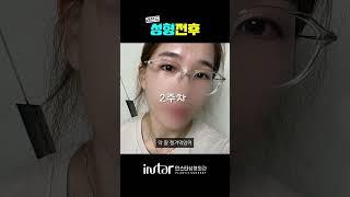 쌍수 안어울리는 얼굴, 무쌍눈매교정하면? 🫢 #강남성형외과 #강남성형 #무쌍 #무쌍눈매교정 #무쌍성형 #인스타성형외과  #강남역성형외과