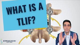 How I perform a TLIF (and what to expect after)