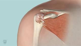 Mayo Clinic Minute: When is rotator cuff surgery right for you?