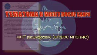 ВНУТРИМОЗГОВАЯ ГЕМАТОМА после удара и ПЕРЕЛОМ основания черепа на РАСШИФРОВКЕ КТ головного мозга