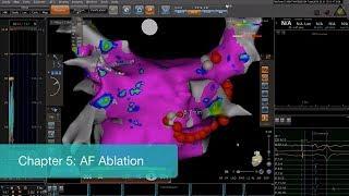 Efficient AF Ablation Workflow With CARTO®3 System And Ablation Index - Chapter 5