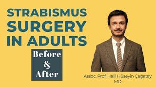 Strabismus Surgery: Before and After in Adult (Exotropia Surgery)