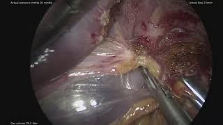 Toupet fundoplication operation 2