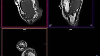 MR MSK Imaging - GOThumb @ 3T