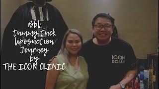 My tummy tuck,BBL,Liposuction journey by THE ICON CLINIC WITH Doc YAPPY