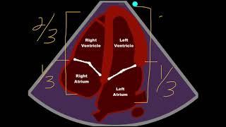 POCUS - Assessing Cardiac Chamber Size