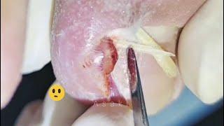 Cut Dirty Ingrown Toenail 剪大脏向内生长脚趾甲 #shorts #video #health