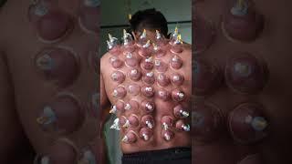 #drycupping #bodybuilding #backpainrelief #musclebuilding #musclerelaxation #chennai #bengaluru