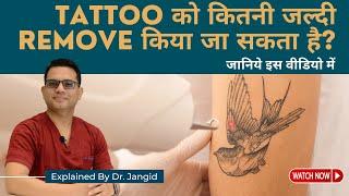 How quickly can a tattoo be removed? | Laser Tattoo Removal in Delhi | SkinQure