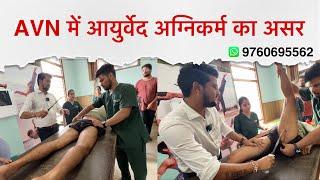 AVN, कूल्हे में सड़न का ईलाज - AYURVEDA AGNIKARMA 