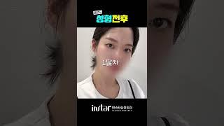 안검하수 있는 무쌍 쌍꺼풀 없이 교정만하고 싶다면? #성형외과 #강남성형외과 #무쌍 #무쌍눈매교정 #무쌍쌍수 #무쌍성형 #눈매교정 #절개눈매교정 #안검하수 #안검하수후기