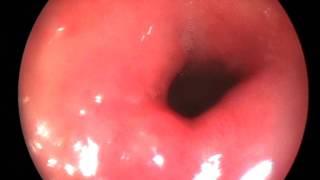 Endoscopy