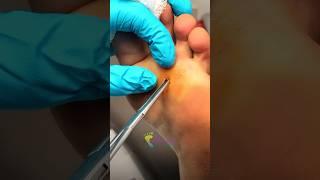 Pulling a Construction Nail Out of a Foot! 