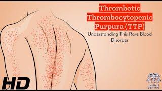 TTP Breakdown: A User-Friendly Guide to Thrombotic Thrombocytopenic Purpura