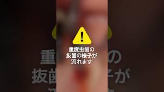 【閲覧注意】寝ている間に虫歯を大量抜歯‼️#歯医者 #抜歯 #dentist #ザホワイトデンタルクリニック#虫歯