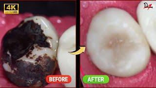 SATISFYING Restoration of Tooth with Hard Calculus and Caries #asmr