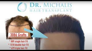 FUE Hair Transplant  Hair Transformation Before After Result Progress - 3086 Grafts  Dr. Michalis