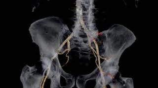 Post traumatic bleeding from iliofemoral artery with incidental AVM