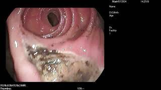 Anastomotic Ulcer (виразка гастроентероанастомозу)