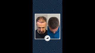 Hair Transplant Turkey - Jones's 9 Months Result