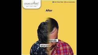 Hair Transplant Results-Before And After: Looks Studio Hair Transplant