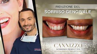 Come Ridurre il Sorriso Gengivale - Studio Cannizzo