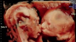 Ultrasound Captures Sweet Moment Between Twins in the Womb