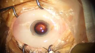 Subconjunctival Chemosis in Phaco Surgery: Management