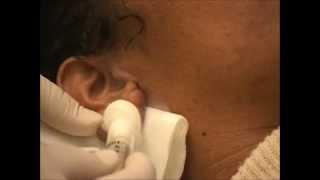 Keloid Removal - Keloid Treatment - NYC Keloid Specialist Doctor -